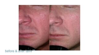 FDAApproved LaViv Fibroblast Treatment  Maryland Laser Skin amp Vein [upl. by Faber]