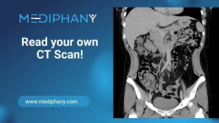 How to read your own CT scan [upl. by Riobard]