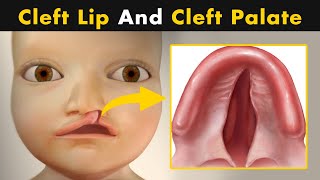 What Causes Cleft Lip And Cleft Palate  symptoms Causes And Treatment UrduHindi [upl. by Fulbright]