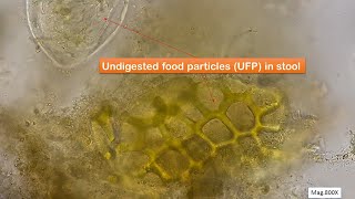 Undigested food particles in faeces Microscopy at 400X and 800X [upl. by Kcirrez]