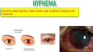 Hyphema Sign Symptoms Causes Risk factor and Treatment Everything is covered in this video [upl. by Lenoel]