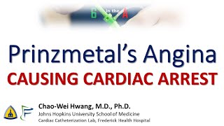 Prinzmetals Angina causing Cardiac Arrest [upl. by Lorre]