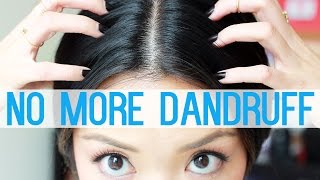 HOW TO Get Rid Of Dandruff [upl. by Mcintyre]