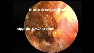 A special case of cholesteatoma clearance in the external auditory canal 12 min [upl. by Anaeda]