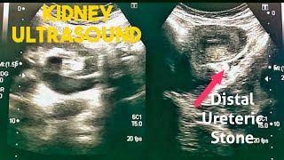 How to Renal Ultrasound  Hydronephrosis Hydroureter Distal Ureteral Stone [upl. by Reina]