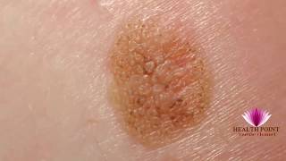 Melanoma Pictures  Signs Symptoms Causes Photos Images Pictures of Melanoma Skin Cancer [upl. by Hameerak159]