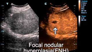 FocalNodularHyperplasia CEUS [upl. by Ecyla]