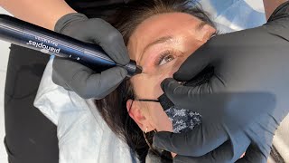 NON SURGICAL EYE LIFT WITH PLASMA PEN  Dr Jason Emer  West Hollywood CA [upl. by Noivax]