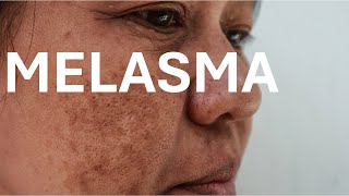 Melasma মাইহীঙ [upl. by Winnick]