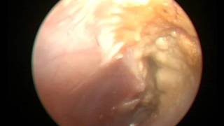 CHRONIC SUPPURATIVE OTITIS MEDIA WITH ATTIC PERFORATION [upl. by Luwana401]