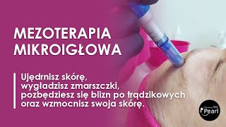 Mezoterapia mikroigłowa  najlepszy zabieg odmładzający [upl. by Anivla291]