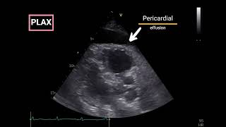 Pericardial Effusion with Doppler Echocardiographic criteria for Tamponade [upl. by Gasper]