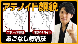 【アデノイド顔貌】脱・横顔コンプレックス！骨切りせずにアゴなしを解消する方法 [upl. by Ettennil]