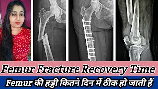 Femur Fracture Recovery Time  Femur Fracture Treatment fracturevlog [upl. by Lilia]