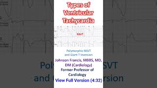 Types of Ventricular Tachycardia [upl. by Macpherson352]