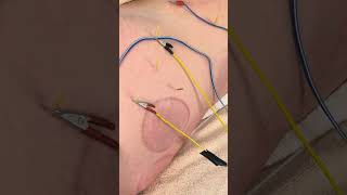 Hip Pain treated with Dry Needling Electrical Stim and Acupuncture in a Marathon Runner [upl. by Nnahtebazile]