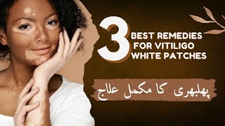 This Remedy CURES Vitiligo White Patches  Arsenic Sulph Flavus [upl. by Nashom]