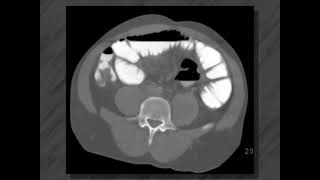 Small bowel disease  Ct enteroclysis [upl. by Dolan]