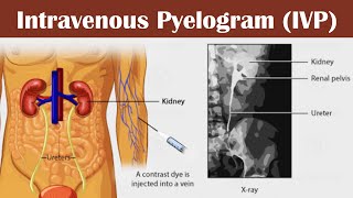 Intravenous pyelogram IVP [upl. by Drain]