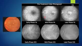 Polypoidal Choroidal Vasculopathy [upl. by Tirrej]