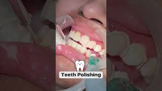 Step By Step Teeth Polishing  Smile Designing  Happy Smiles dental Care  shorts [upl. by Haye188]