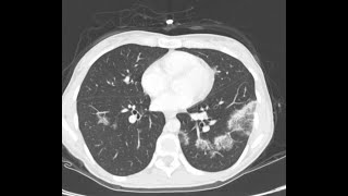 CT CHEST V11 CARDIOGENIC PUL EDEMA EOSINOPHILLIC PN SEPTIC EMBOLI AND BRONCHOPNEUMONIA lungs [upl. by Matronna108]