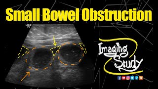 Small Bowel Obstruction  Ultrasound  Case 152 [upl. by Tila530]