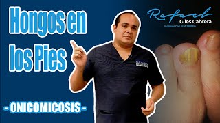 Onicomicosis Hongos en los pies [upl. by Nitsug]