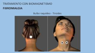 Fibromialgia Tratamiento con biomagnetismo 8 [upl. by Gregoor]