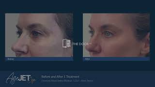 AgeJET for Eye Rejuvenation  The Door W4  NonSurgical Eye Lift Using Nitrogen Plasma [upl. by Eikcaj]