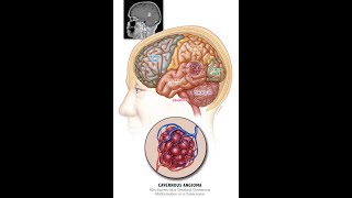 cavernoma  hge mets [upl. by Cirdla]