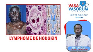 LYMPHOME HODGKINIEN  Toni Entuku  VASAVASORUM ClubMed [upl. by Eintrok]