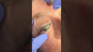 Would you do this to protect eyes before laser treatment on eyelids dermatologist [upl. by Volny784]