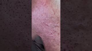 hairremoval blackhead skincare [upl. by Llehsim]