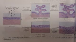 Urothelial Transitional Cell Carcinoma  SPECIAL PATHOLOGY [upl. by Sedrul]