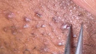 Pluck with me episode 7 satisfying removingingrown ingrownhairremoval [upl. by Claudelle779]