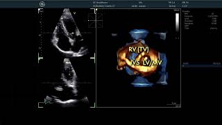 〖Echocardiography〗 The Tricuspid Valve in 3D  TTE 🫀 [upl. by Namolos460]