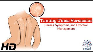 Tinea Versicolor Unveiled Causes Symptoms and Solutions [upl. by Stockton]