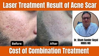 Laser Treatment Result of Acne Scar Treatment  Cost of Combination Treatment [upl. by Valenka494]