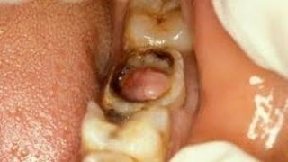 Pulp Poly  Chronic Hyperplastic Pulpitis  Dentalks [upl. by Zumstein985]