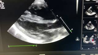 Sinus Venosus ASD of IVC type [upl. by Carma]