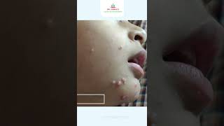 Clear Skin with Homeopathy Molluscum Relief  Dr Sonal Jain  Molluscum Treatment in Mumbai [upl. by Ahsitneuq336]