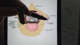 Spinal cord tumors Differences between Intra and Extramedullary lesions [upl. by Zap823]