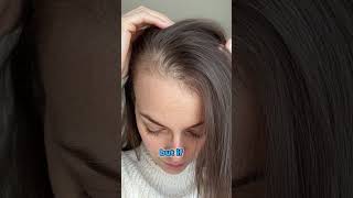 FEMALE HAIR LOSS  GENETICS AND DHT EXPLAINED  TOP SCALP [upl. by Hajidak266]