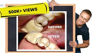 Class II cavity restoration  STEPBYSTEP [upl. by Thomasin944]