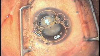 Anterior capsular dyes  ICG VS Trypan blue [upl. by Alisan]