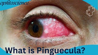 what is pinguecula symptoms sign treatment preventions [upl. by Basia]