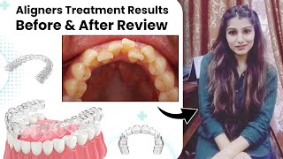 Aligners Invisalign Treatment Results Review Testimonial  Invisible Braces in Pakistan [upl. by Mellie]