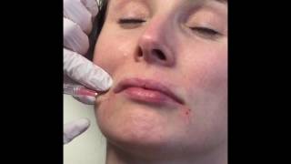 Dermal Filler with Neauvia  Organic Collagen stimulating filler [upl. by Nakeber]