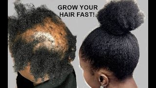 YOUR HAIR WILL GROW LIKE CRAZY GROW HAIR Long Thick amp Healthy FAST [upl. by Fonda]